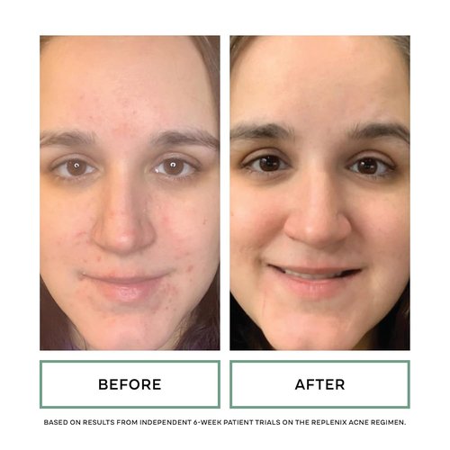 Replenix BP Acne Face Wash - Non-Oily Benzoyl Peroxide Cleanser for Acne-Prone Skin | 6.7 Fl Oz
