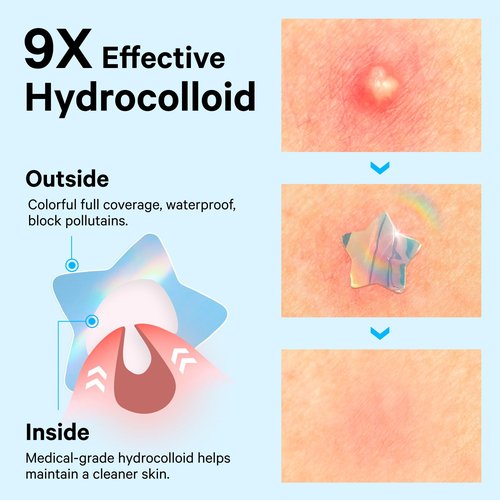 Sosky Hologram Pimple Patches for Face, Hydrocolloid Acne Patches with Salicylic Acid, Cute Star Zit Stickers,Colorful Blemish Covers,144 Count Blue Star Heart Moon Cloud Butterfly Flower