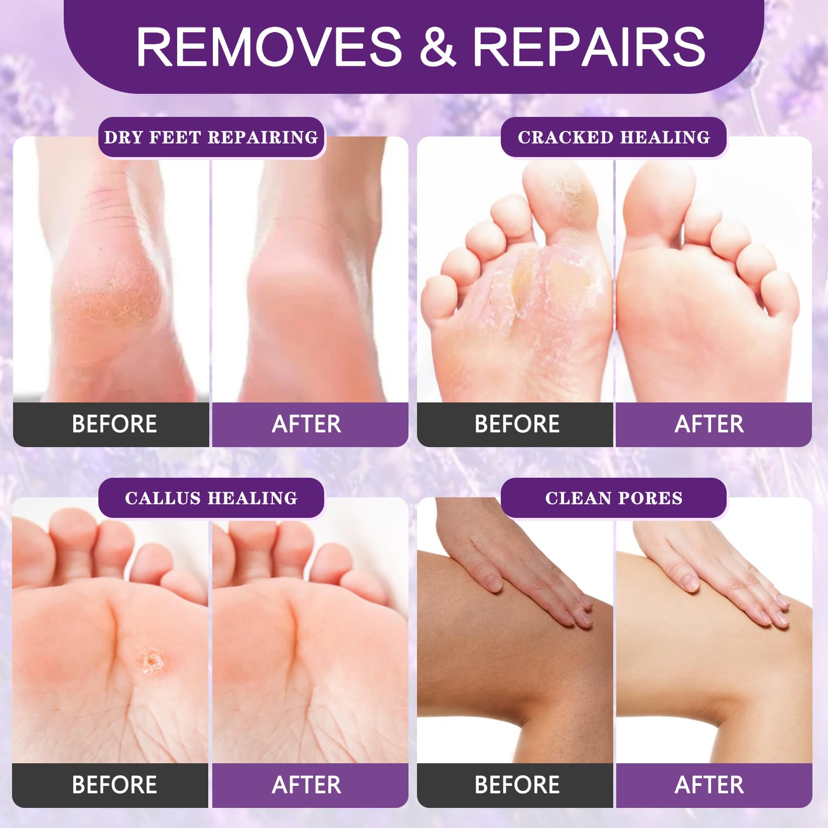 XIWEIOO Foot Callus Remover Gel Foot Files Kit Heel Foot Callus Remover Gel Exfoliator Dead Skin Remover Pedicure Foot Spa Products Home Pedicure Foot Spa Supplies for Rough, Dry, Cracked Skin