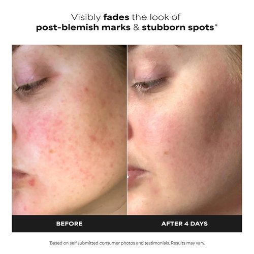 Paula's Choice BOOST 10% Azelaic Acid Serum - Oil-Free Skin Brightening Gel for Face, Fragrance-Free