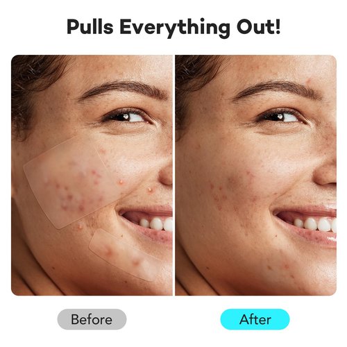 LitBear Large Pimple Patches for Face (6 Sizes 401 Counts), Big Hydrocolloid Acne Patches, XL Hydrocolloid Bandages for Body, Cheek, Forehead, Chin, Full Face, Back, Nose