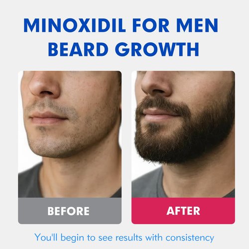 5% Minoxidil for Men Hair Regrowth Treatment, Extra Strength Topical Solution for Thinning Hair & Balding, Beard Growth Enhancer, Non-Greasy Fast-Absorbing Formula, 4-Pack (240ml) 4-Month Supply
