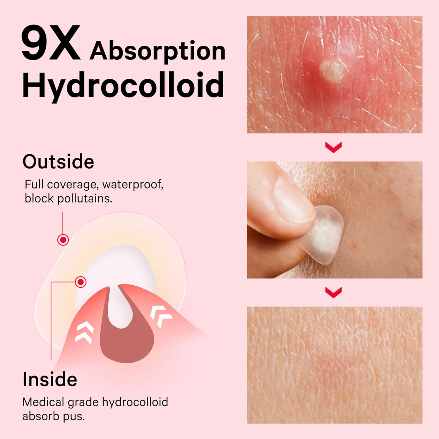 Sosky Pimple Patches - Invisible Hydrocolloid Acne Stickers with Salicylic Acid | 48 Count for Clear Skin