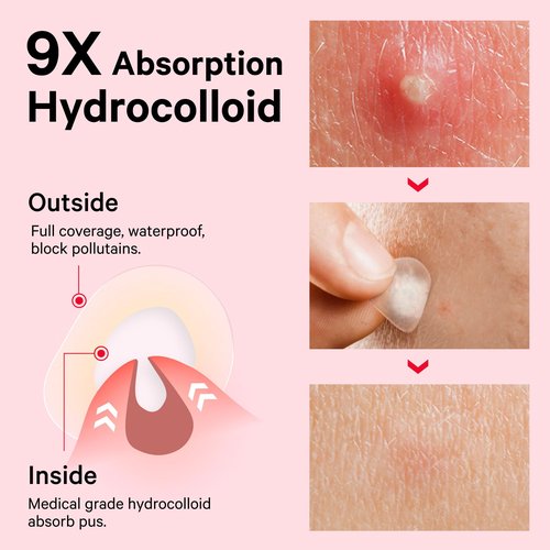 Sosky Pimple Patches for Face, FSA HSA Eligible Invisible Hydrocolloid Acne Patches, Zit Sticker for Face and Skin, Pimple Sticker for Covering Zits, Blemishes with Salicylic Acid 144 Count