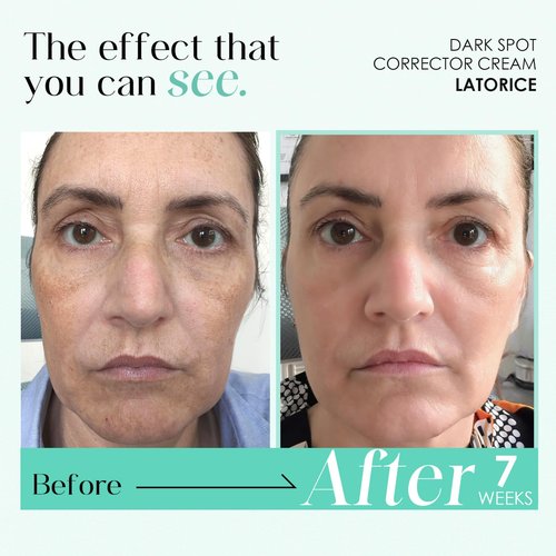 Dark Spot Remover for Face and Body: Tranexamic Acid Serum for Women and Men - Reduce Sun Spot Melasma Freckles - Natural Ingredient Enriching Skin Care (1.7 Fl Oz)