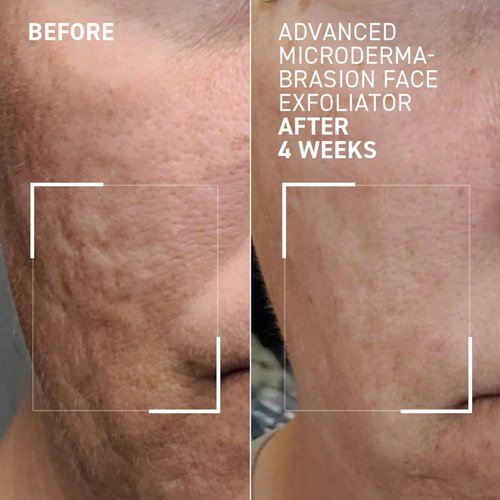 Dr. Brandt Microdermabrasion Exfoliator - Travel Size 0.7 oz | Refines Texture & Minimizes Fine Lines