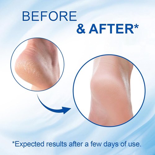 Regine Switzerland 60% Urea Cream Stick - Maximum Strength Foot Cream with 2% Salicylic Acid for Dry, Cracked Heels | Rapid Callus Remover