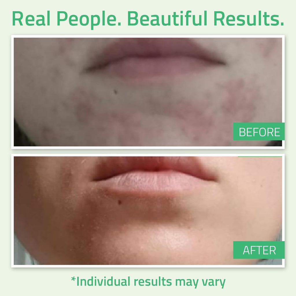 YEOUTH Glycolic Acid Peel - At-Home Chemical Exfoliator with 30% AHA & Retinol | Refresh & Smooth Skin 1oz