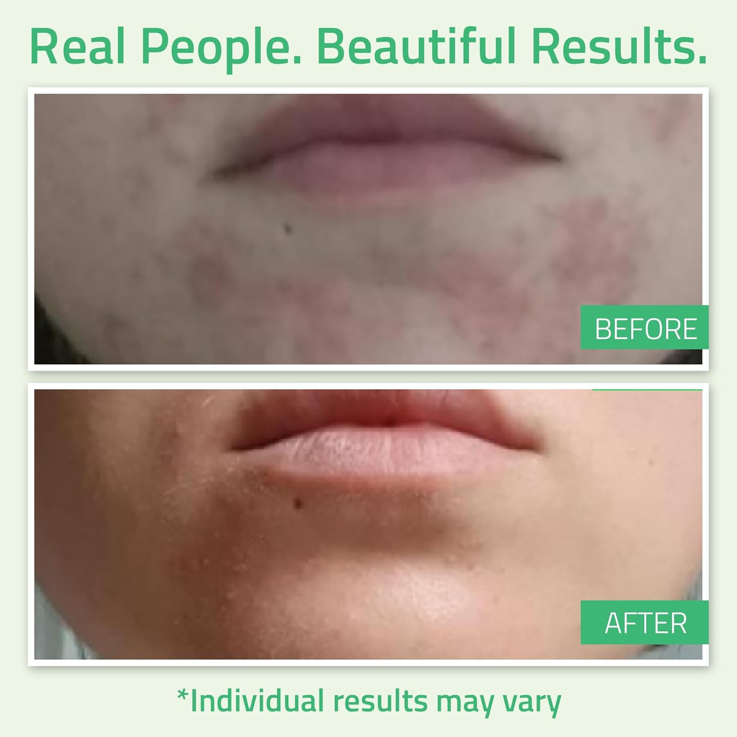 YEOUTH Glycolic Acid Peel - At-Home Chemical Exfoliator with 30% AHA & Retinol | Refresh & Smooth Skin 1oz