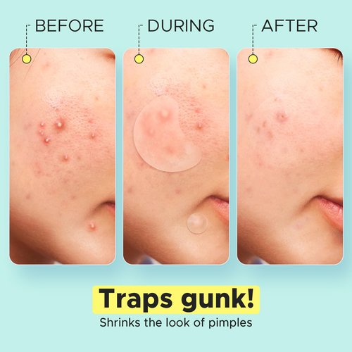 LitBear Pimple Patches for Face, Large Acne Patch, XL Hydrocolloid Bandages,Zit Stickers for Forehead, Chin, Nose, Body, Back, and Chest, Includes Crescent, Square, and Dot (5 Sizes, 507 Patches)