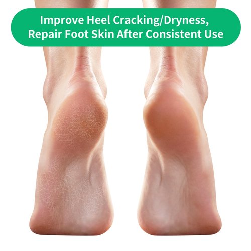 Cracked Heel Treatment Repair Socks - Ohtomber 5 Pairs Silicone Gel Foot Care Softener Toeless Pedicure Moisturizing Dry Feet Socks for Dry Cracked Heels