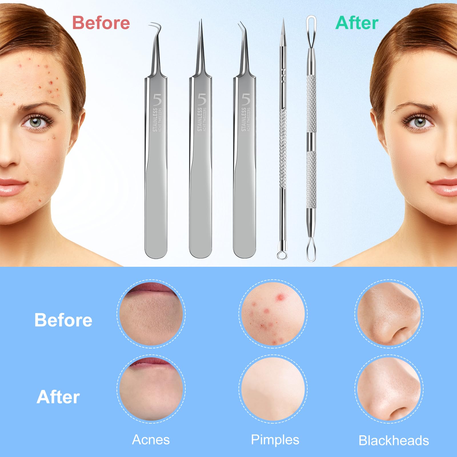YGQQOY Blackhead Remover Tweezers, Pimple Popper Tool Kit, Ingrown Hair Tweezers, Blackhead Extractor, Skin Zit Acne Blemish Popping Removing Surgical Tweezers Tools for Nose Eye Face