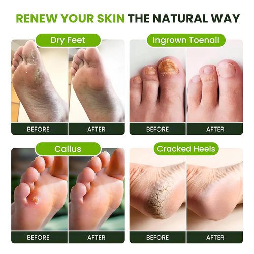 Tea Tree Oil Foot Soak - Epsom Salt Formula for Toenail Repair & Sore Feet Relief | 16 oz Made in USA