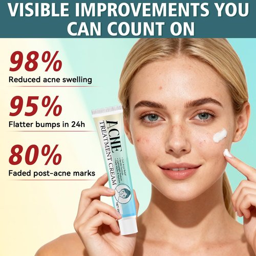 Acne Treatment for Face, Acne Cream, Pimple Cream Suitable for All Skin, Blemish Care Cream for Face and Body, Gentle Daily Skin Care for Oily & Blemish-Prone Skin, Helps Improve Skin Appearance