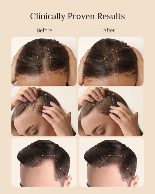 DR ZERO Women's Hair Growth Serum - 3% Redensyl Treatment for Thinning Hair, Clinically Tested, 60ml