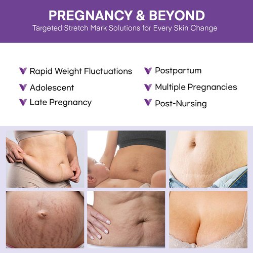 Stretch Mark Cream for Pregnant Women: Stretch Mark Treatment for Pregnancy - Belly Butter For Pregnant Women - Massage Lotion To Prevent And Repair Maternity Stretch Marks Scar - 4 Oz