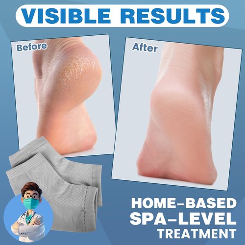 TEAWOO Moisturizing Toeless Socks for Cracked Heels - Heel Repair, Hydrate Dry Feet