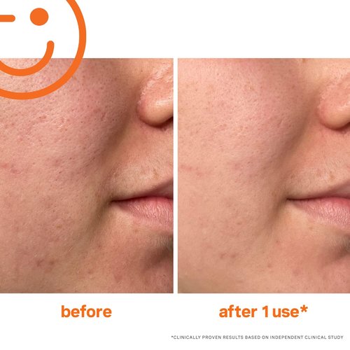 Kate Somerville ExfoliKate™ Intensive Exfoliating Treatment - Salicylic & Lactic Acid Facial Scrub | 1.7 Fl Oz