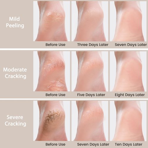 Mouriven Urea Cream 40 Percent - Foot & Hand Cream for Dry, Cracked Heels, Feet, Knees, Elbows, and Hands - Maximum Strength Urea Lotion for Softening and Moisturizing