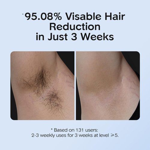 INNZA IPL Hair Removal with Ice Cooling Care Function for Women,Long-Lasting Results,999,999 Flashes Painless Hair Removal, Hair Removal Device for Armpits Legs Arms Bikini Line