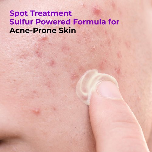 GLAM UP Spotless 10% Sulfur Treatment Serum - Fast Healing for Pimples & Acne | 15mL (0.5 fl. oz.)