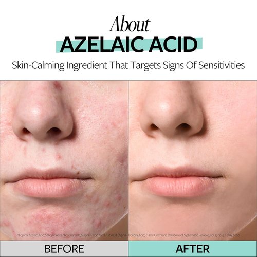 RECIPE Azelaic Acid 10 Soothing Ampoule - Soothing Facial Serum for Sensitive Skin | Korean Skincare (1.01 fl oz)