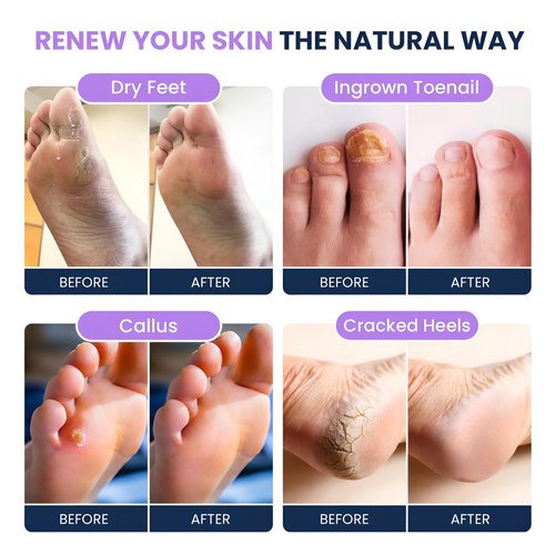 FOOT CURE Tea Tree Oil & Soothing Lavender Foot Soak with Epsom Salt - Best Toenail Treatment & Softens Calluses - Soothes Sore & Tired Feet, Foot Odor Scent, Spa Pedicure - 16 oz (Pack of 2)