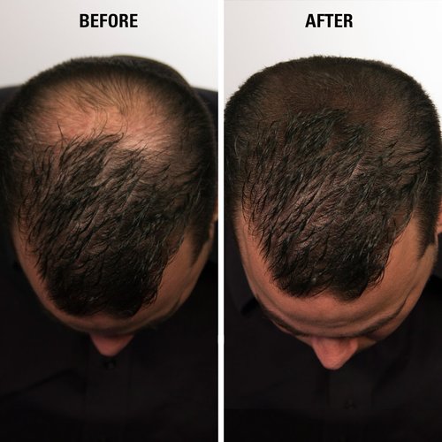 INFINITY Hair Fibers Black for Thinning Hair for Women & Men - 100% Undetectable Hair Building Fiber Powder - Conceal Hair Loss in 15 Seconds, 30g