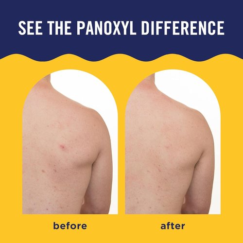 PanOxyl Acne Banishing Body Spray - 2% Salicylic Acid Treatment for Stubborn Breakouts | 6 Oz