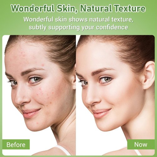 Eofot 14% Azelaic Acid Acne Cream, Azelaic Acid For Face, Helps Improve the Appearance of Acnes - Azalecic Acids Acido Azelaico, 1 Fl Oz