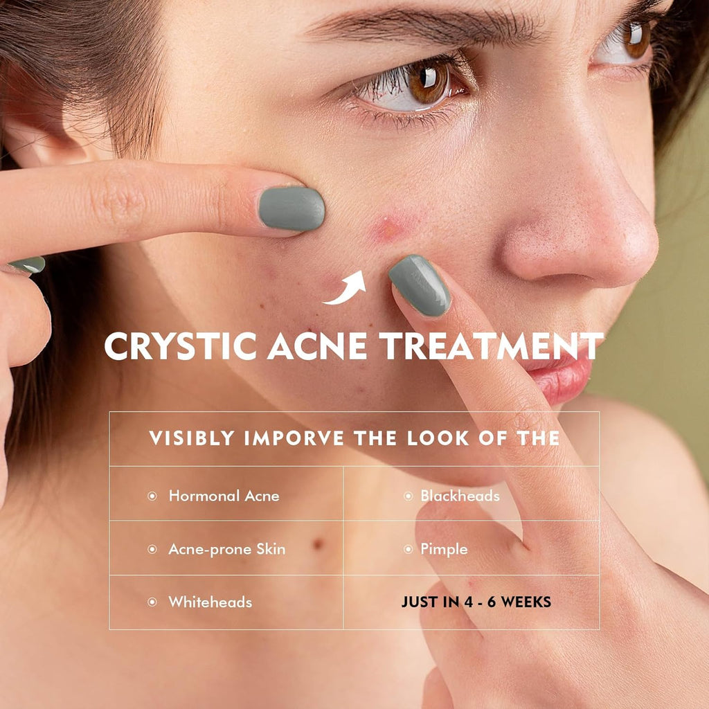 Azelaic Acid Serum by [Brand Name] - Acne Treatment with 10% Azelaic & Salicylic Acid | 30ml for Sensitive Skin