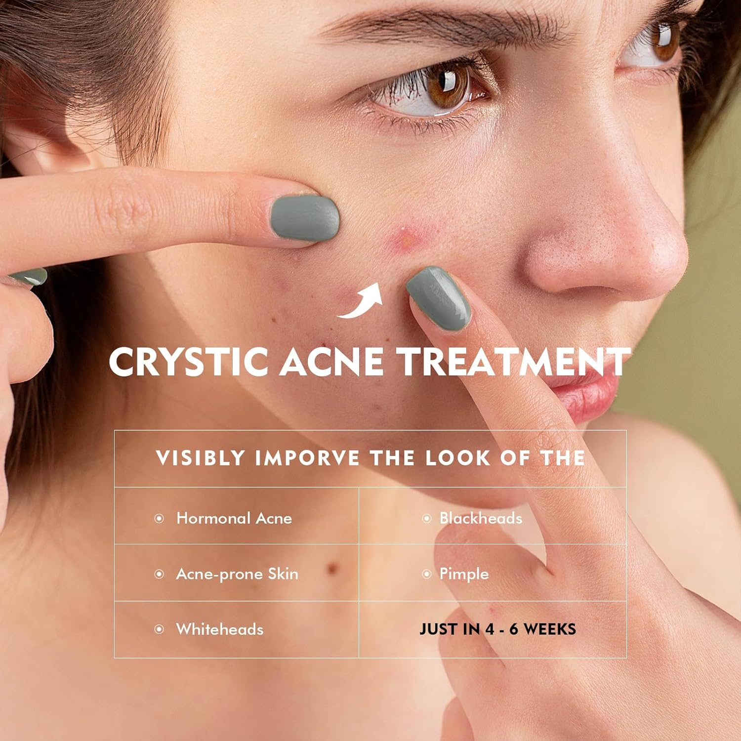 Azelaic Acid Serum by [Brand Name] - Acne Treatment with 10% Azelaic & Salicylic Acid | 30ml for Sensitive Skin