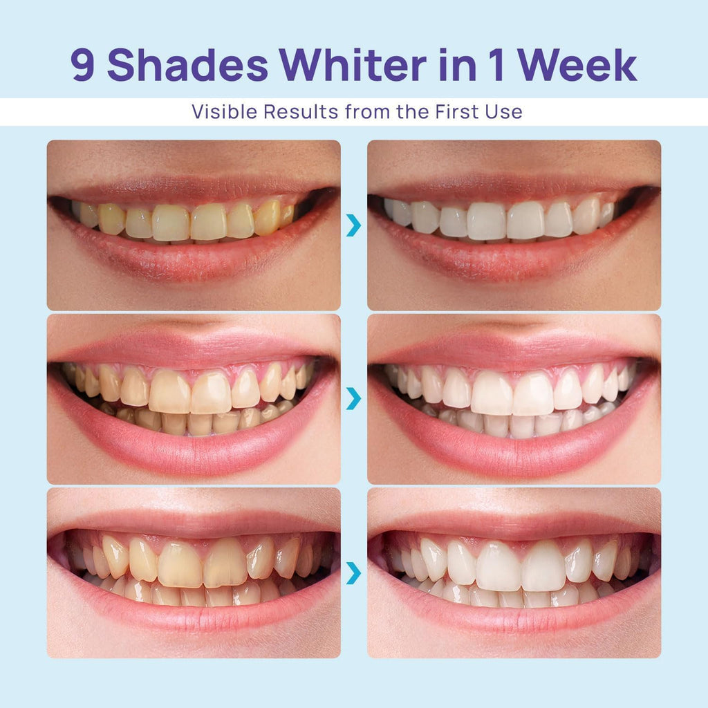 Whitebite Pro Teeth Whitening Kit - Dental-Grade Whitening for Sensitive Teeth | 32X LED Light + 35% Carbamide Peroxide Gel + Mint Flavor
