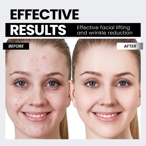 Microcurrent Facial Device,Latest Red Light Technology，Enhances The Ability to Lift The Face and Tighten The Skin，Facial Wrinkle Equipment，Smart Photon Micro-Current Device, Model:EP-300.