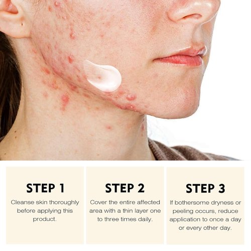 Regine Switzerland Acne Treatment Cream - Rapid Clearing for Hormonal & Cystic Acne | 30g
