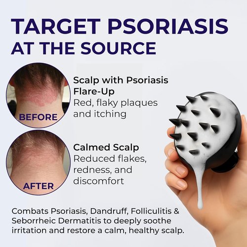 Psoriasis Shampoo - Medicated Anti-Dandruff Solution for Flaky Scalp & Seborrheic Dermatitis - 200ml