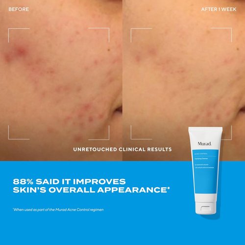 Regine Switzerland Acne Treatment Trial Kit - Salicylic & Mandelic Acid for Clear Skin - Travel Size for Acne-Prone Skin