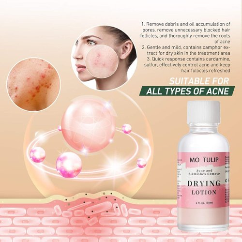 MO TULIP Acne Drying Lotion - Overnight Spot Treatment for Face & Body, 1oz Pimple & Blemish Solution