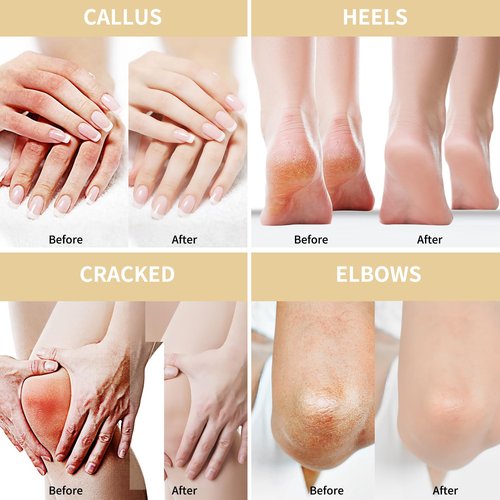 Urea Cream 50 Percent for Feet with Oat 5.29 oz || Foot & Hand Cream Maximum Strength with 2% Salicylic Acid, Tea Tree and Aloe Vera for Deep Moisturizing and Callus Removing (Upgraded Formula)