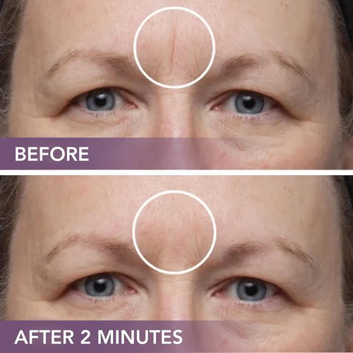 Dermaflage Scar Filler Kit - Waterproof Concealer for Deep Scars - Bronze Dark, 1 Month Supply