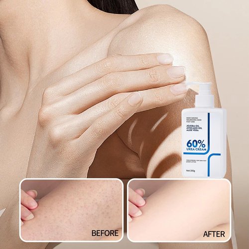 NIZENTA Urea Cream 60 Percent Body Lotion 10.58 Oz, Body Lotion for Dry Skin, Skin Moisturizing Lotion for Extremely Dry Skin, Non Greasy Body Cream