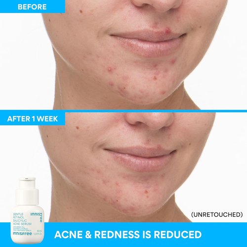 Innisfree Gentle Retinol Salicylic Acne Serum - Korean Face Treatment for Clear Skin & Blemish Control