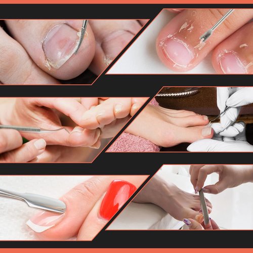 BEZOX Ingrown Toenail Removal Kit - Toenail Lifter and Thick Toenails File, Stainless Steel Pedicure Tools - 6PCS Nail Correction Set