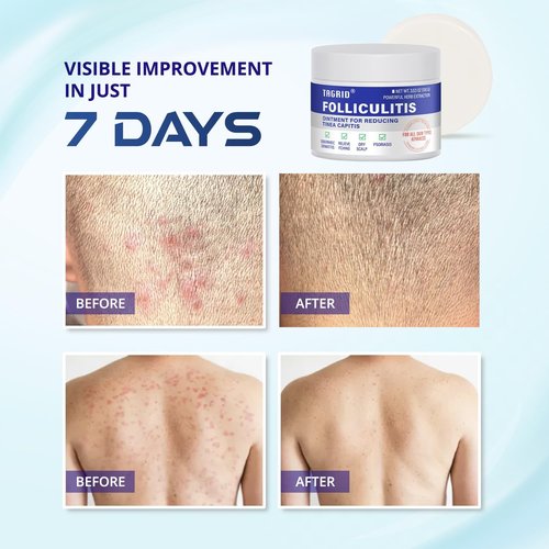 TAGRID Folliculitis Antifungal Treatment Set: Ultimate Duo for Ingrown Hair, Folliculitis Relief and Fungal Skin Care - Antibacterial Soap for Athletes & Active Lifestyles