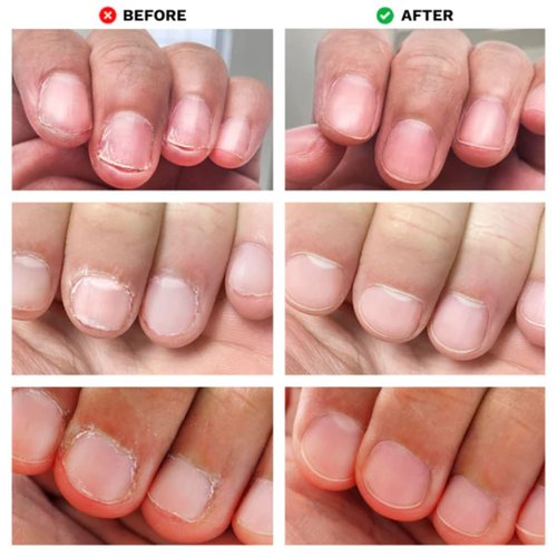 LONDONTOWN No Bite Nail Recovery - Nail Biting Thumb Sucking Deterrent - Bitter Non Toxic Nail Biting Treatment for Kids Adults - Fortified Strengthener and Growth Care Formula .40fl oz