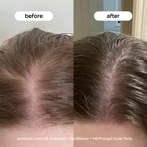BONDIBOOST Procapil Scalp Treatment - Daily Leave-In Serum for Thinning Hair | 4.23 fl oz, Sulfate-Free