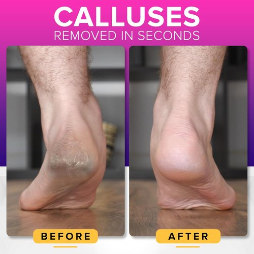 NYK1 Megafile Foot Callus Remover - Rustproof XL Size with Skin Catcher | High-Performance Wet & Dry Use Scrubber