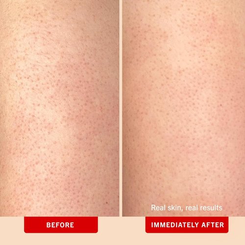 First Aid Beauty - KP Bump Eraser Body Scrub | 10% AHA Exfoliator for Keratosis Pilaris, Peach Scent (2 oz)