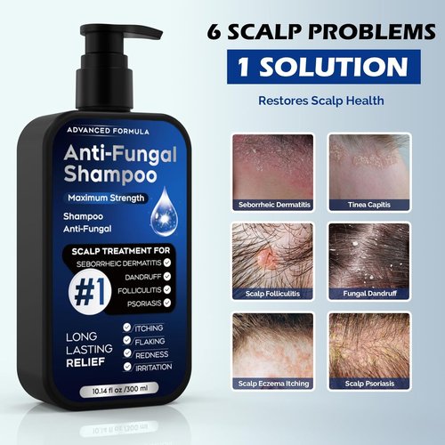 Skiennix Antifungal Psoriasis Shampoo - Relieves Scalp Itching & Dryness | 10.1 Fl Oz, Sulfate-Free