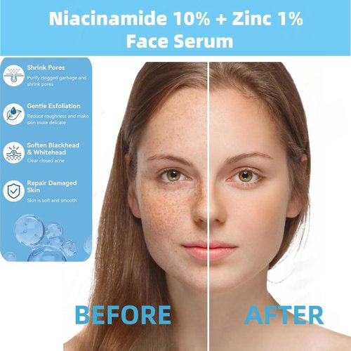 **Skiennix Niacinamide 10% + Zinc 1% Serum - Oil Control & Acne Treatment | Lightweight Non-Greasy, 30ml**